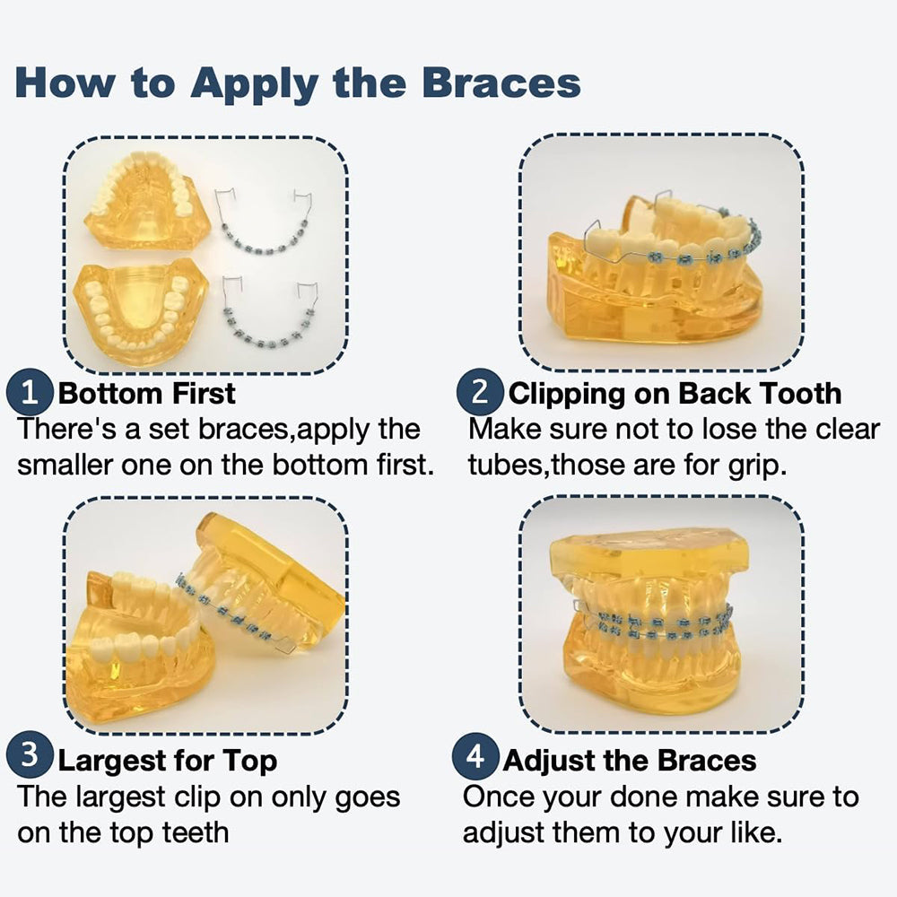 Sakerplus One-Step Fake Braces with Power Chain